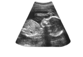 ULTRASOUND